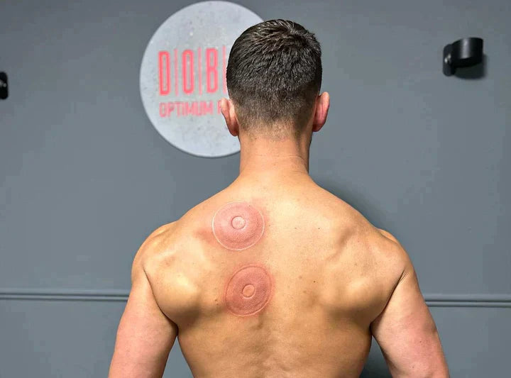 A shirtless man viewed from behind in a gym setting, showing two circular red treatment marks on his upper back