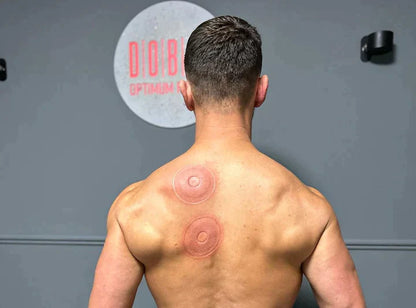 A shirtless man viewed from behind in a gym setting, showing two circular red treatment marks on his upper back